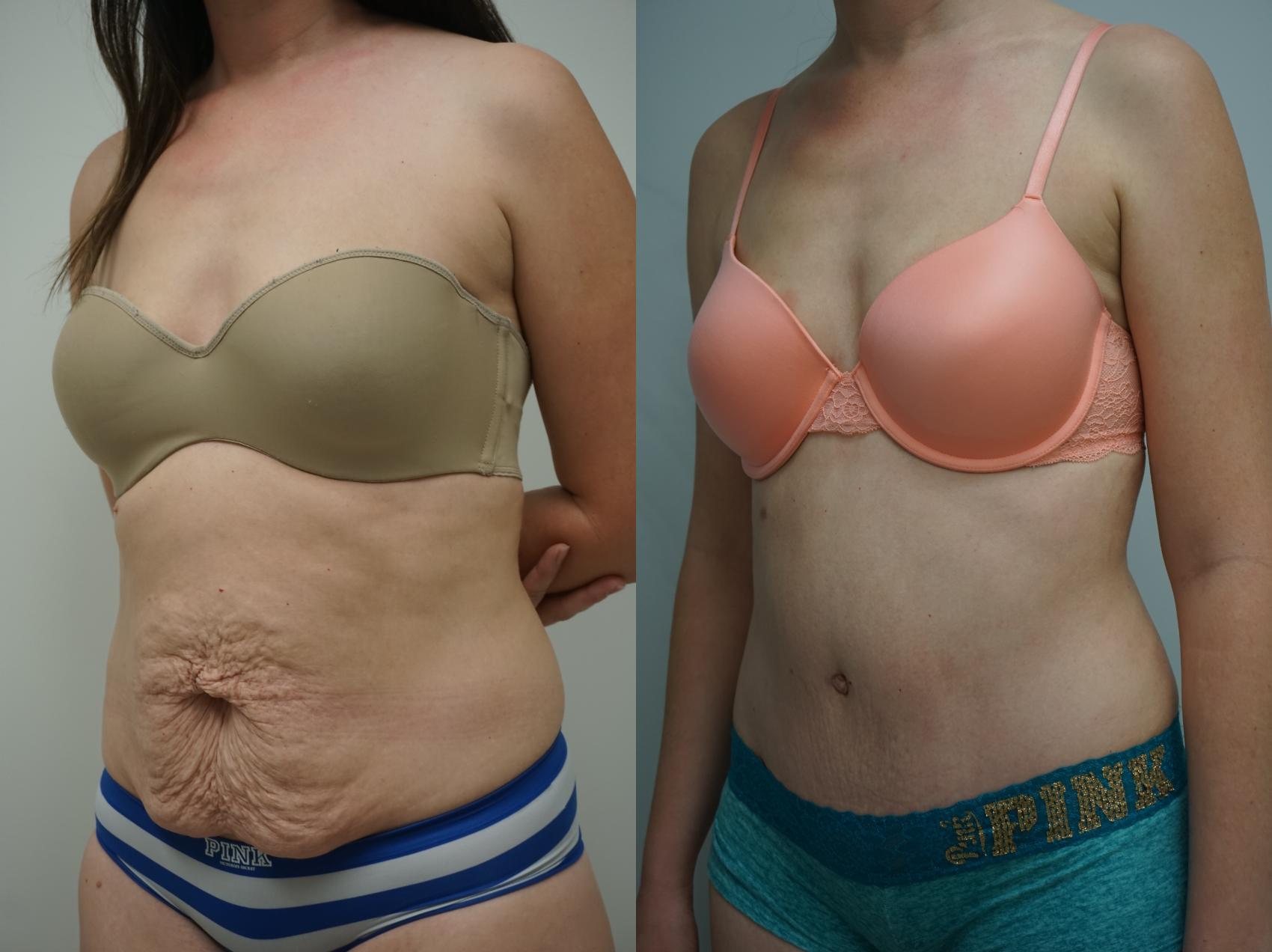 Before & After Tummy Tuck (Abdominoplasty) Case 183 View #3 View in Gilbert, AZ