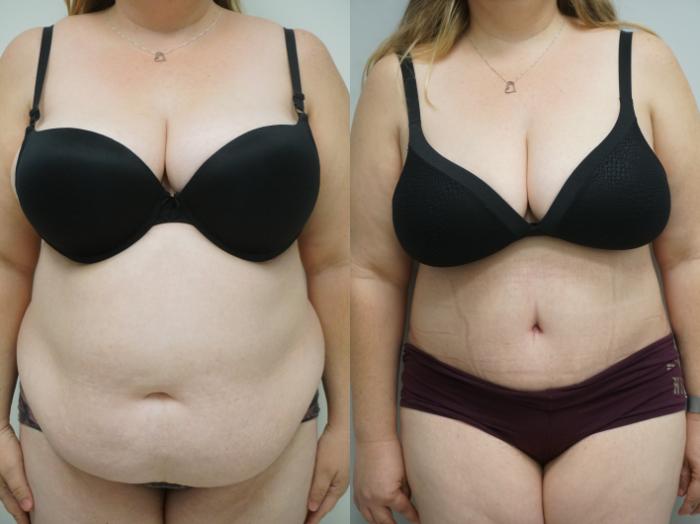 Before & After Tummy Tuck (Abdominoplasty) Case 184 View #1 View in Gilbert, AZ