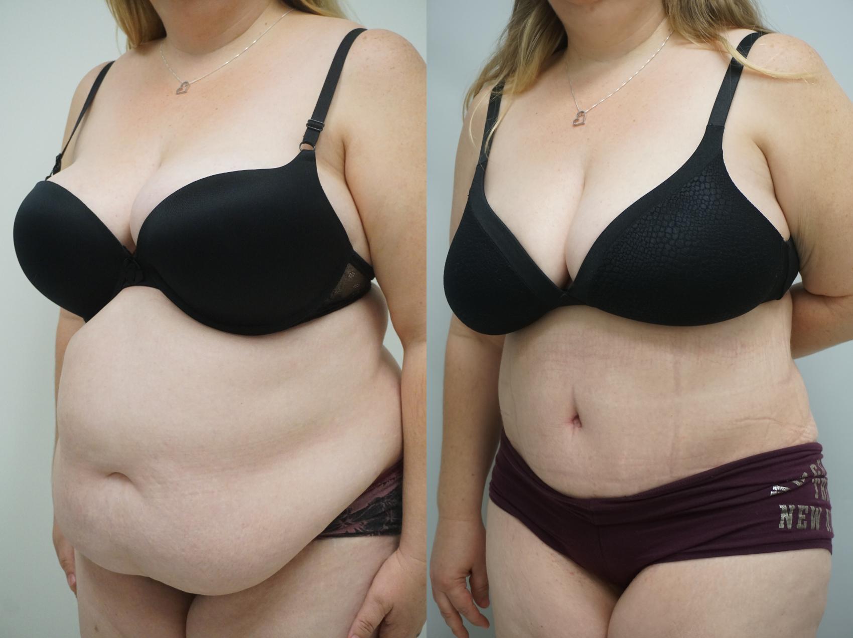 Before & After Tummy Tuck (Abdominoplasty) Case 184 View #2 View in Gilbert, AZ