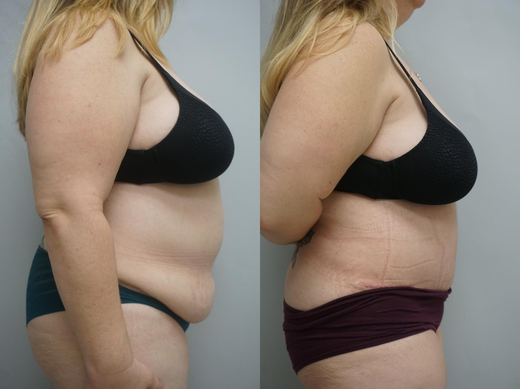 Before & After Tummy Tuck (Abdominoplasty) Case 184 View #3 View in Gilbert, AZ