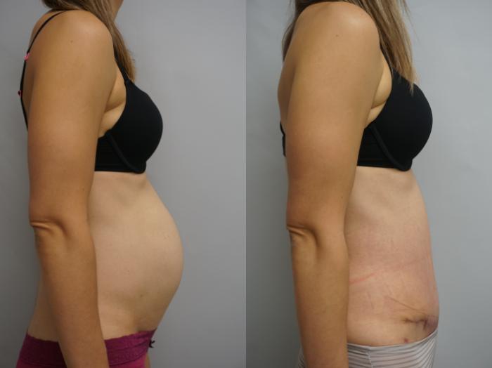 Before & After Tummy Tuck (Abdominoplasty) Case 200 View #1 View in Gilbert, AZ