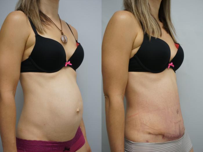 Before & After Tummy Tuck (Abdominoplasty) Case 200 View #2 View in Gilbert, AZ