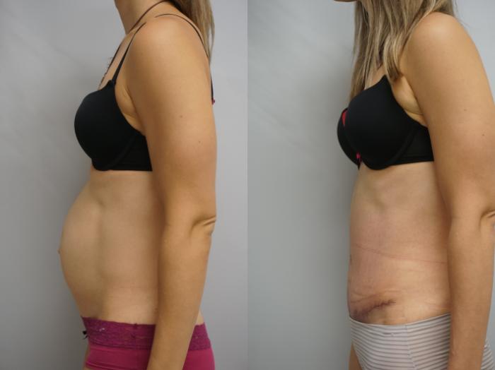 Before & After Tummy Tuck (Abdominoplasty) Case 200 View #3 View in Gilbert, AZ