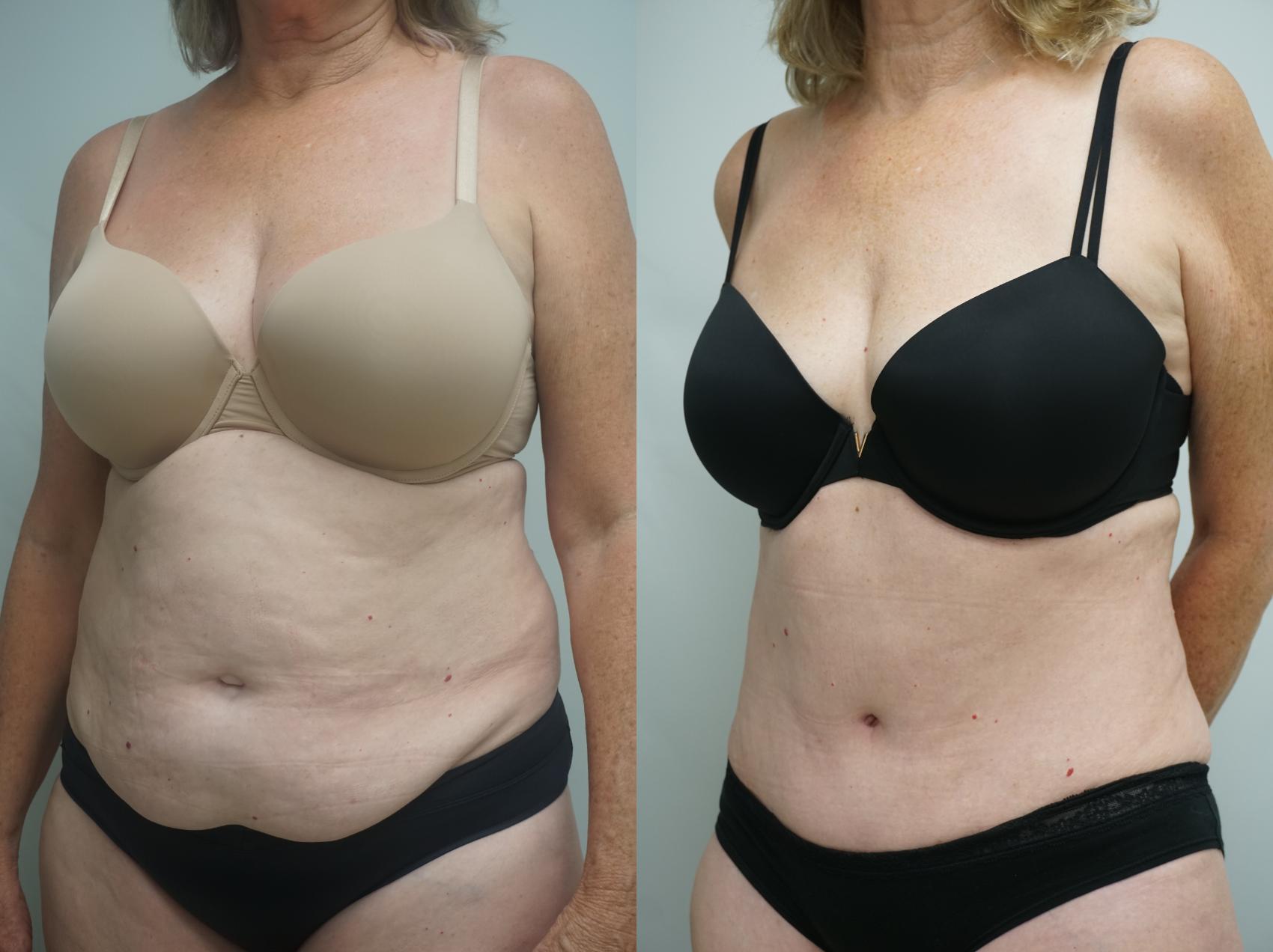 Before & After Tummy Tuck (Abdominoplasty) Case 201 View #1 View in Gilbert, AZ