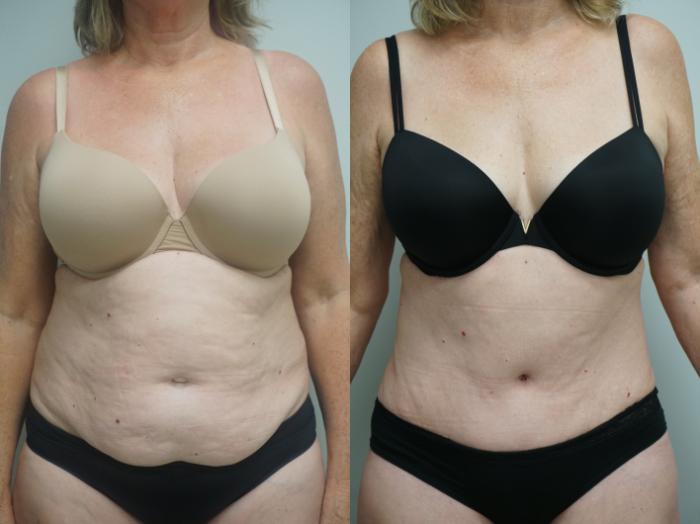 Before & After Tummy Tuck (Abdominoplasty) Case 201 View #2 View in Gilbert, AZ