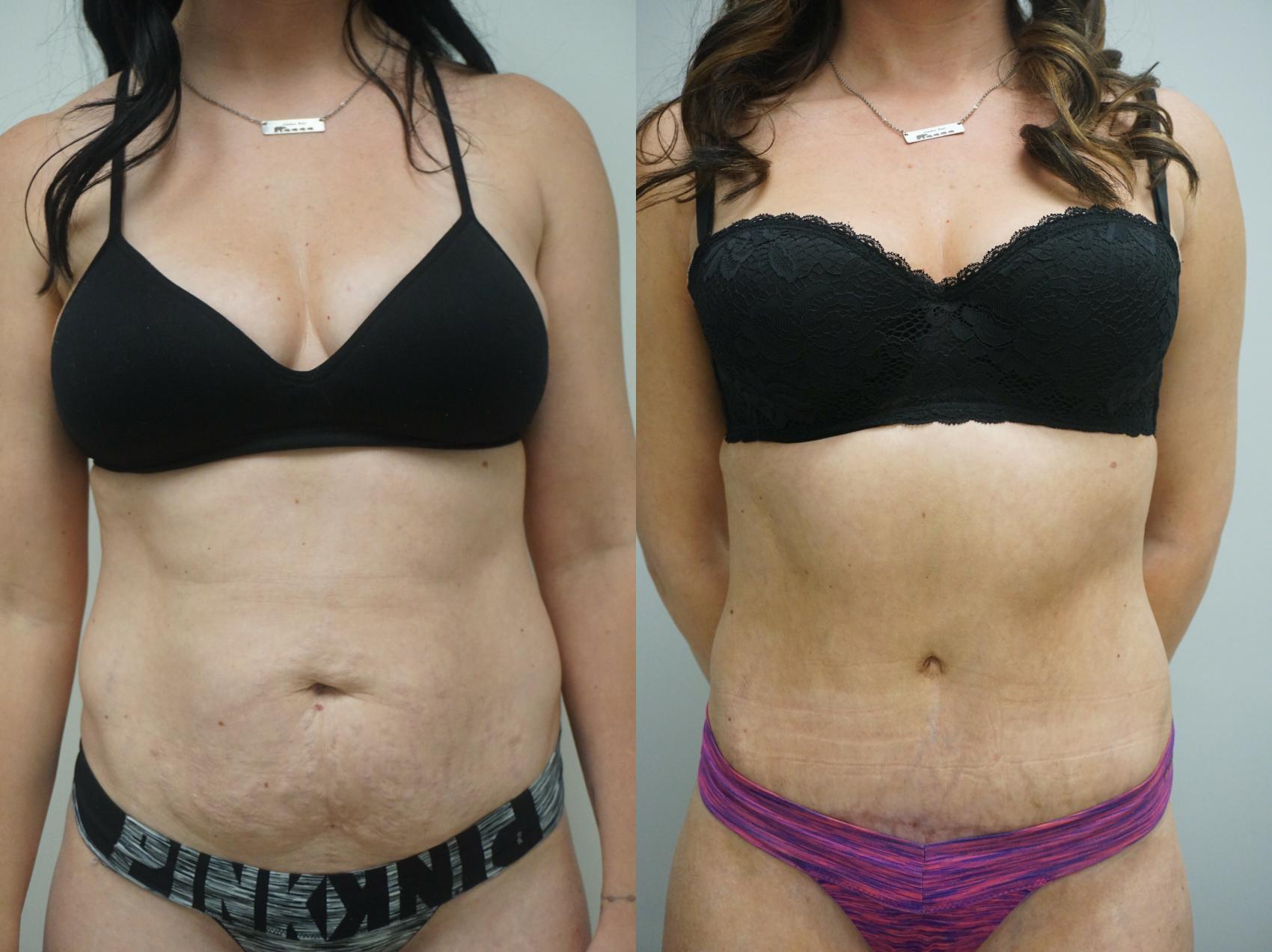 Before & After Tummy Tuck (Abdominoplasty) Case 214 View #1 View in Gilbert, AZ