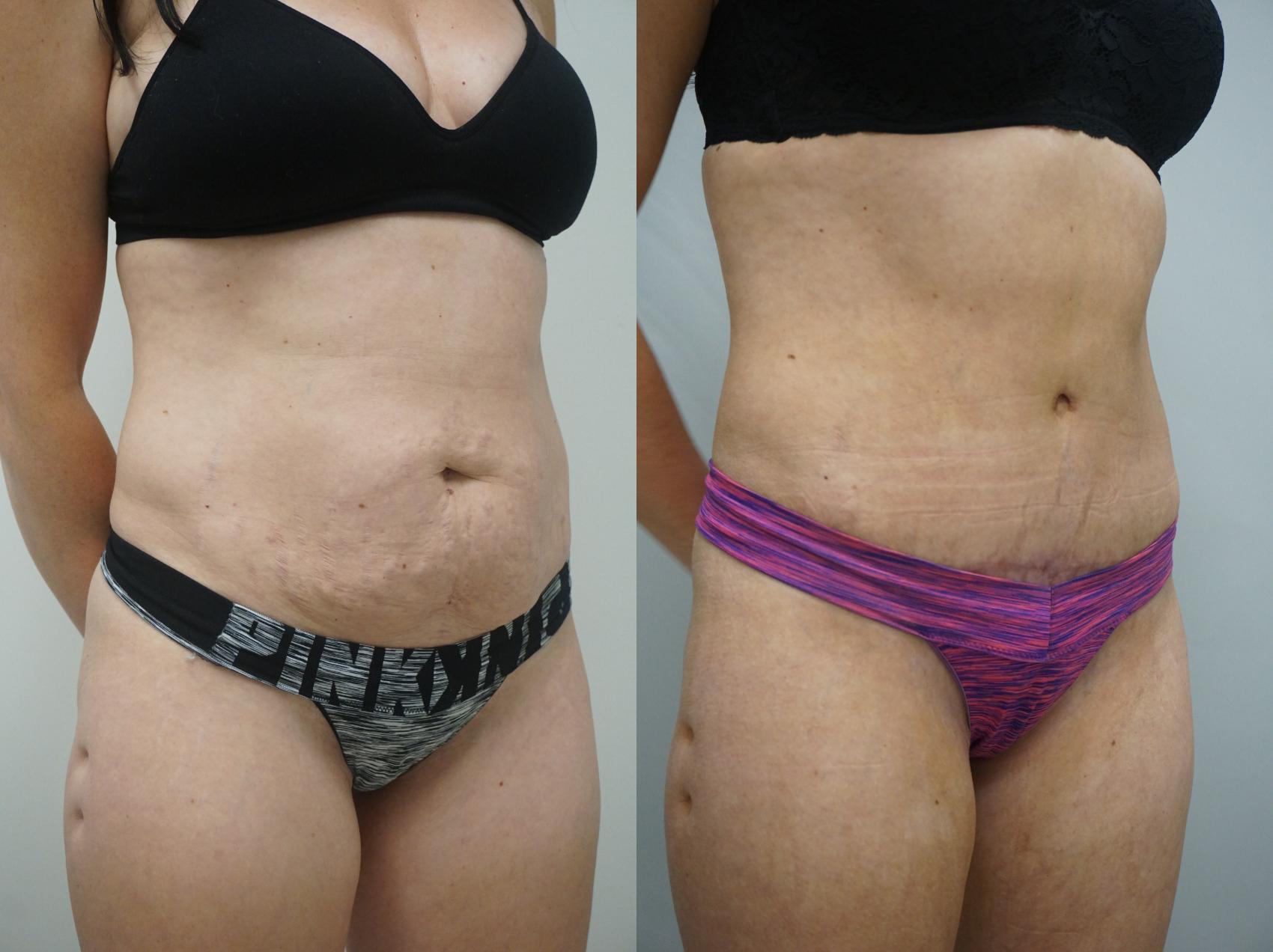 Before & After Tummy Tuck (Abdominoplasty) Case 214 View #2 View in Gilbert, AZ