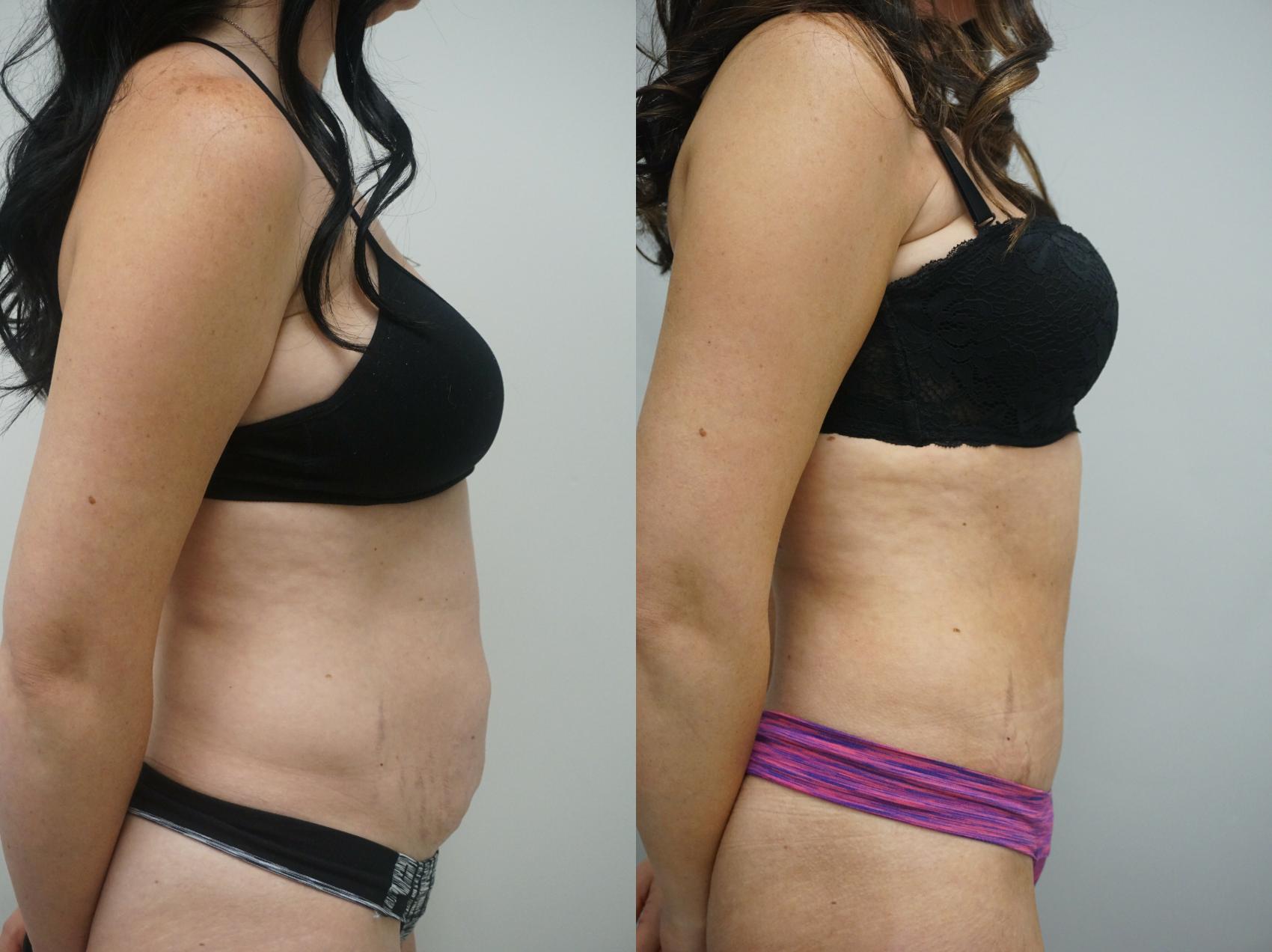 Before & After Tummy Tuck (Abdominoplasty) Case 214 View #3 View in Gilbert, AZ