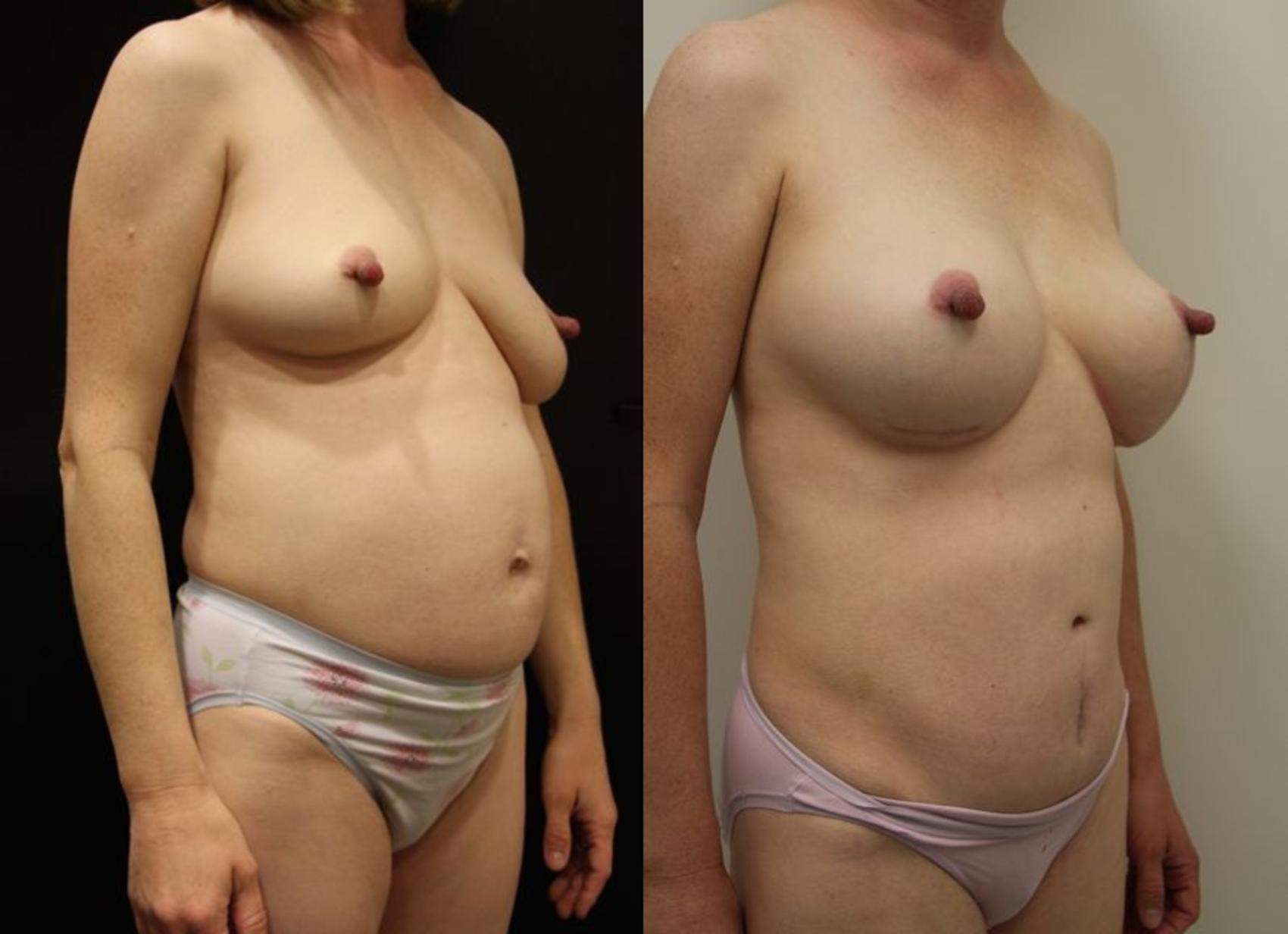 Before & After Tummy Tuck (Abdominoplasty) Case 22 View #1 View in Gilbert, AZ
