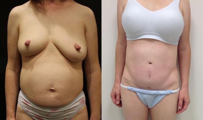 Before & After Tummy Tuck (Abdominoplasty) Case 22 View #2 View in Gilbert, AZ