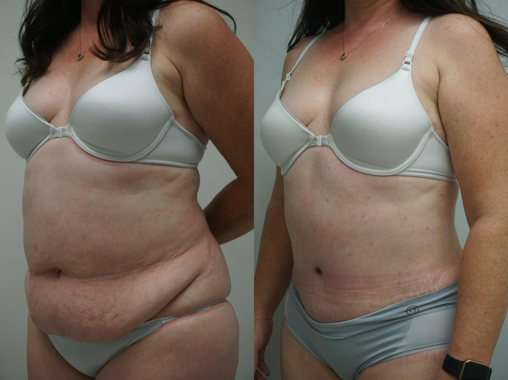 Before & After Tummy Tuck (Abdominoplasty) Case 220 View #1 View in Gilbert, AZ