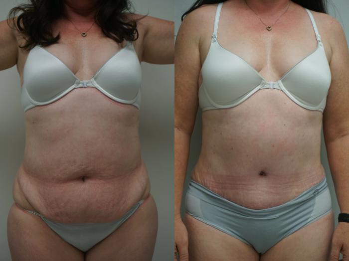 Before & After Tummy Tuck (Abdominoplasty) Case 220 View #2 View in Gilbert, AZ