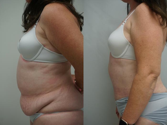 Before & After Tummy Tuck (Abdominoplasty) Case 220 View #3 View in Gilbert, AZ