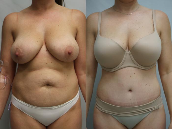 Before & After Tummy Tuck (Abdominoplasty) Case 233 View #1 View in Gilbert, AZ