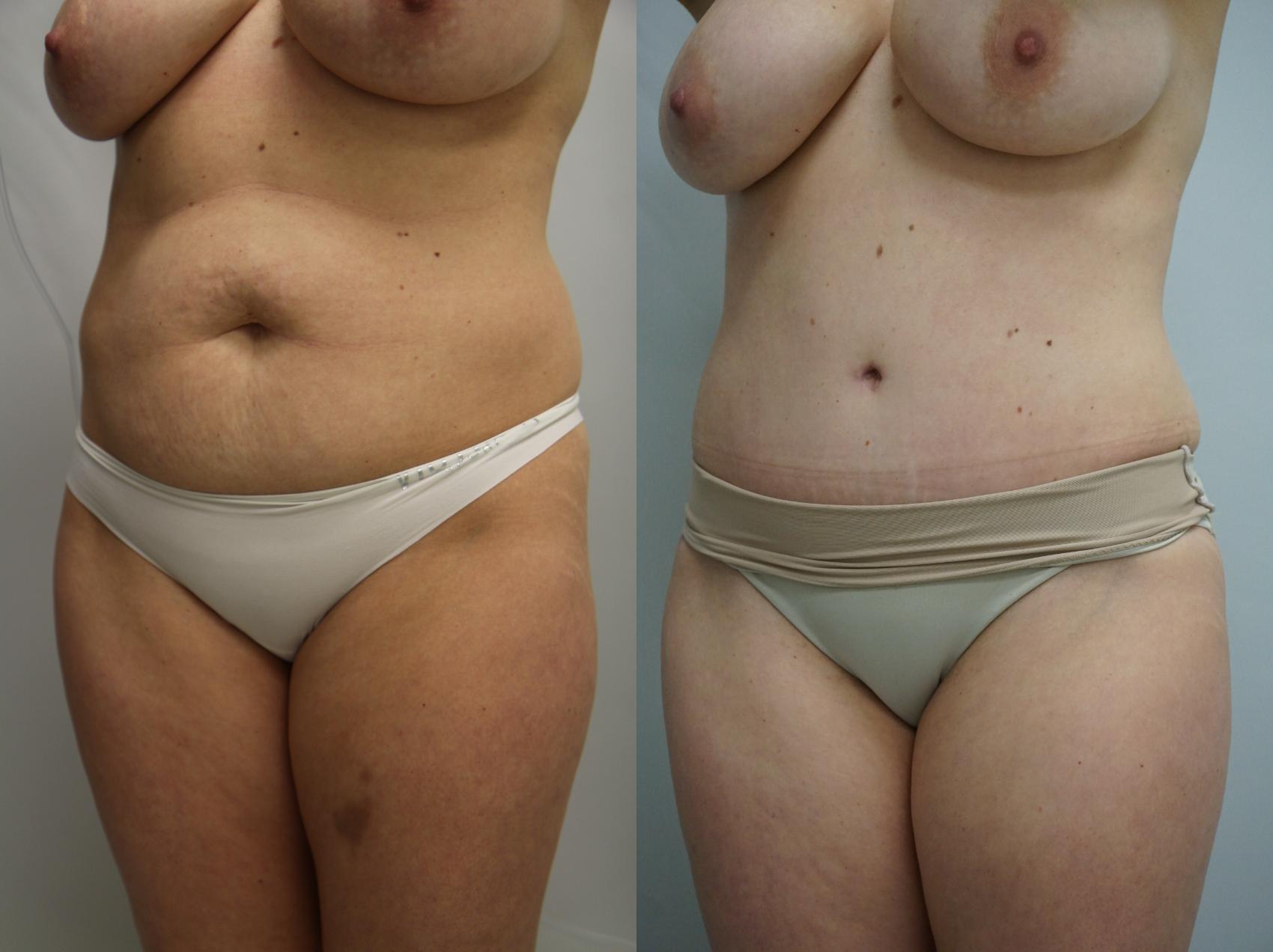 Before & After Tummy Tuck (Abdominoplasty) Case 233 View #2 View in Gilbert, AZ