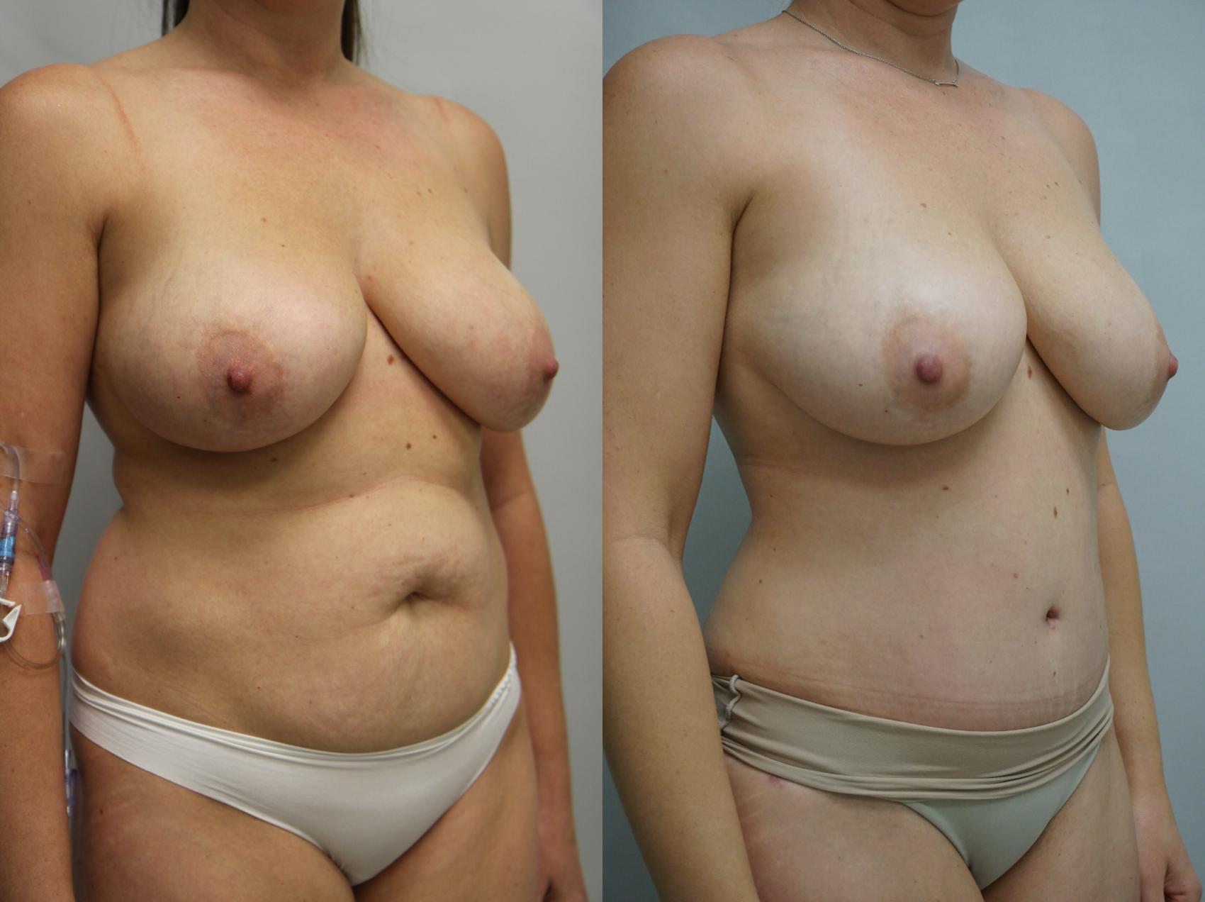Before & After Tummy Tuck (Abdominoplasty) Case 233 View #3 View in Gilbert, AZ
