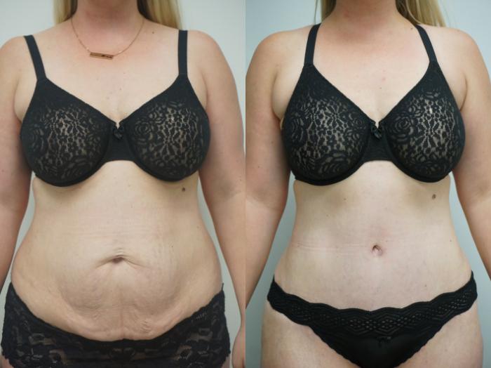 Before & After Tummy Tuck (Abdominoplasty) Case 256 View #1 View in Gilbert, AZ