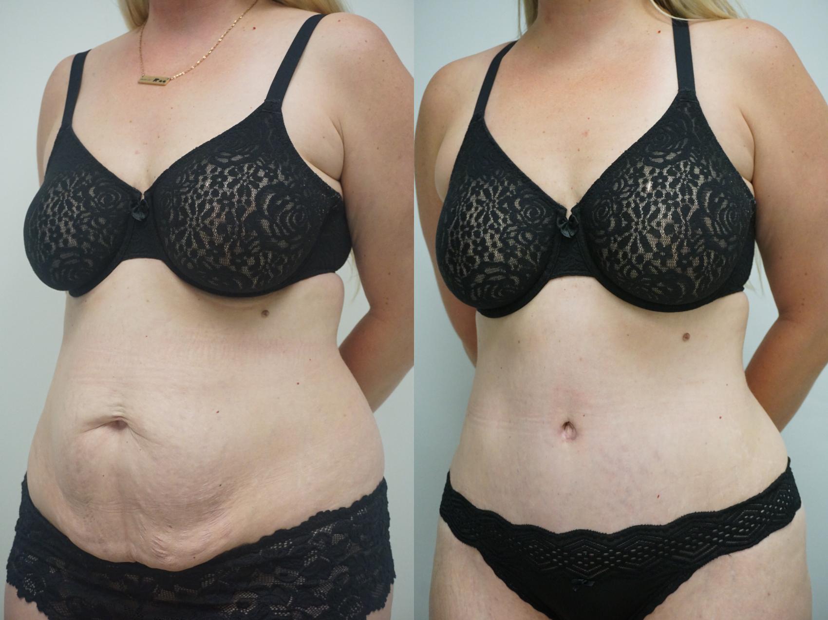 Before & After Abdominoplasty (Tummy Tuck) Case 256 View #2 View in Gilbert, AZ