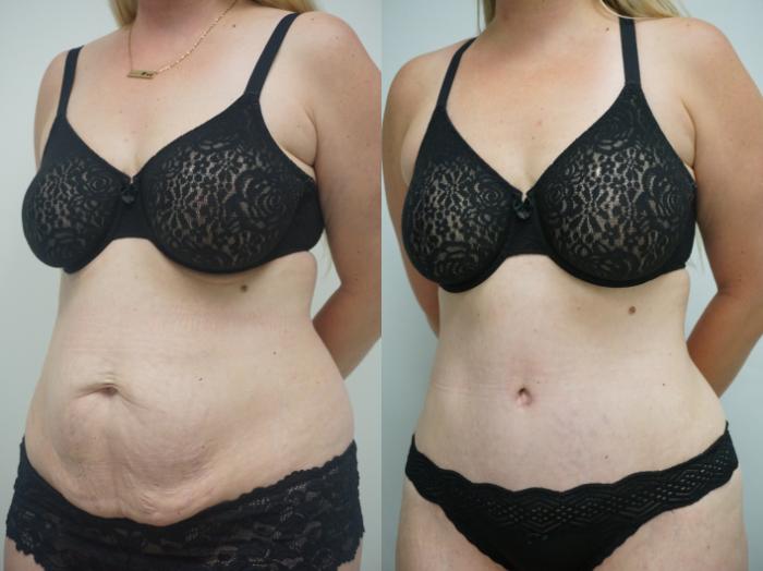 Before & After Tummy Tuck (Abdominoplasty) Case 256 View #2 View in Gilbert, AZ