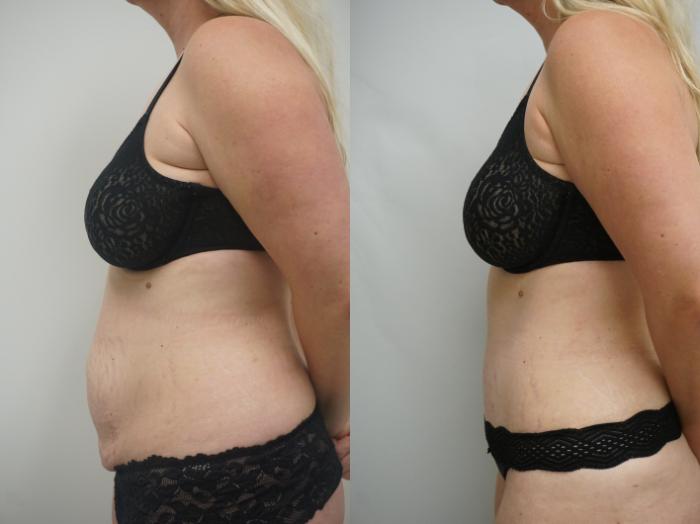 Before & After Tummy Tuck (Abdominoplasty) Case 256 View #3 View in Gilbert, AZ