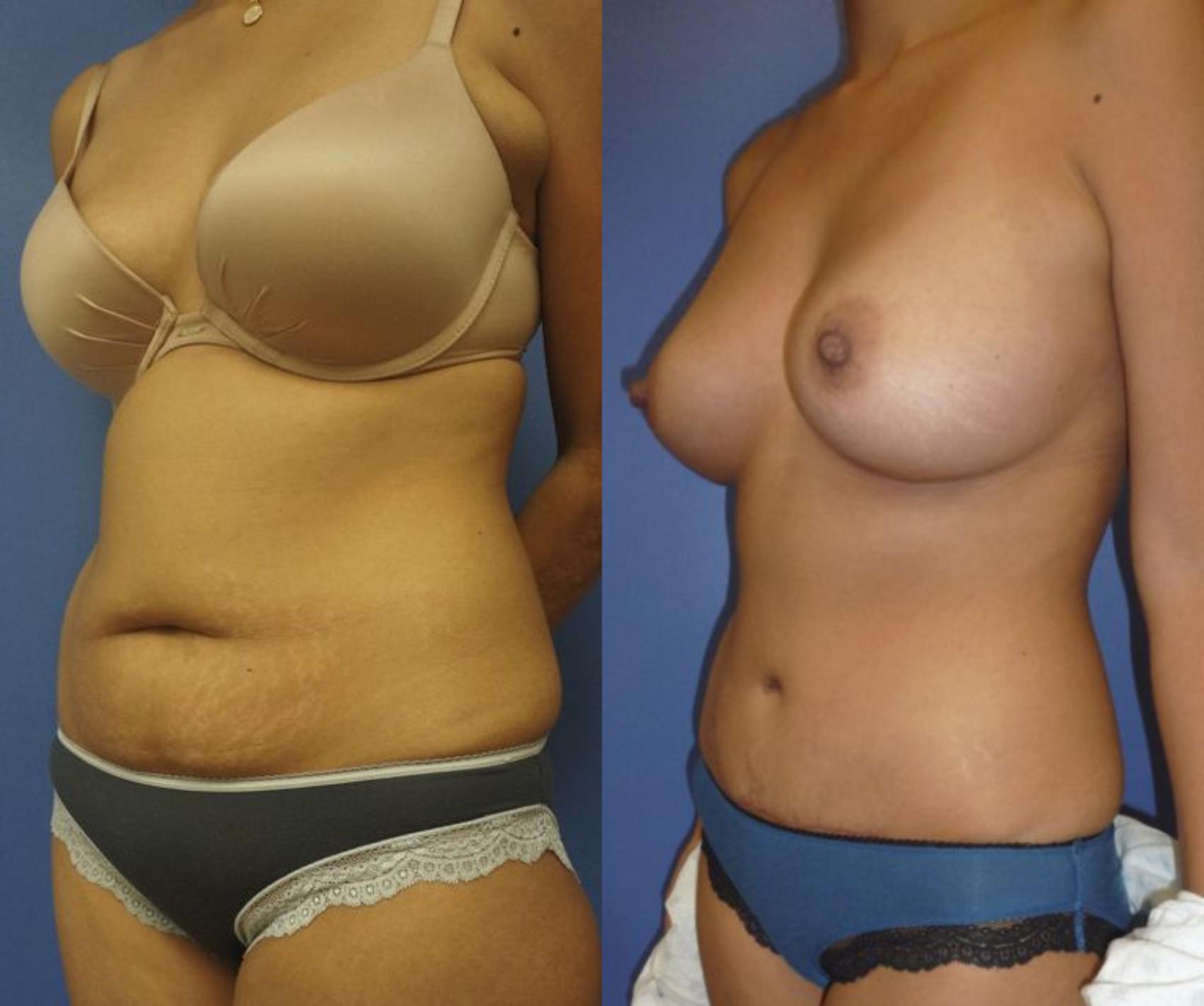 Before & After Tummy Tuck (Abdominoplasty) Case 27 View #1 View in Gilbert, AZ