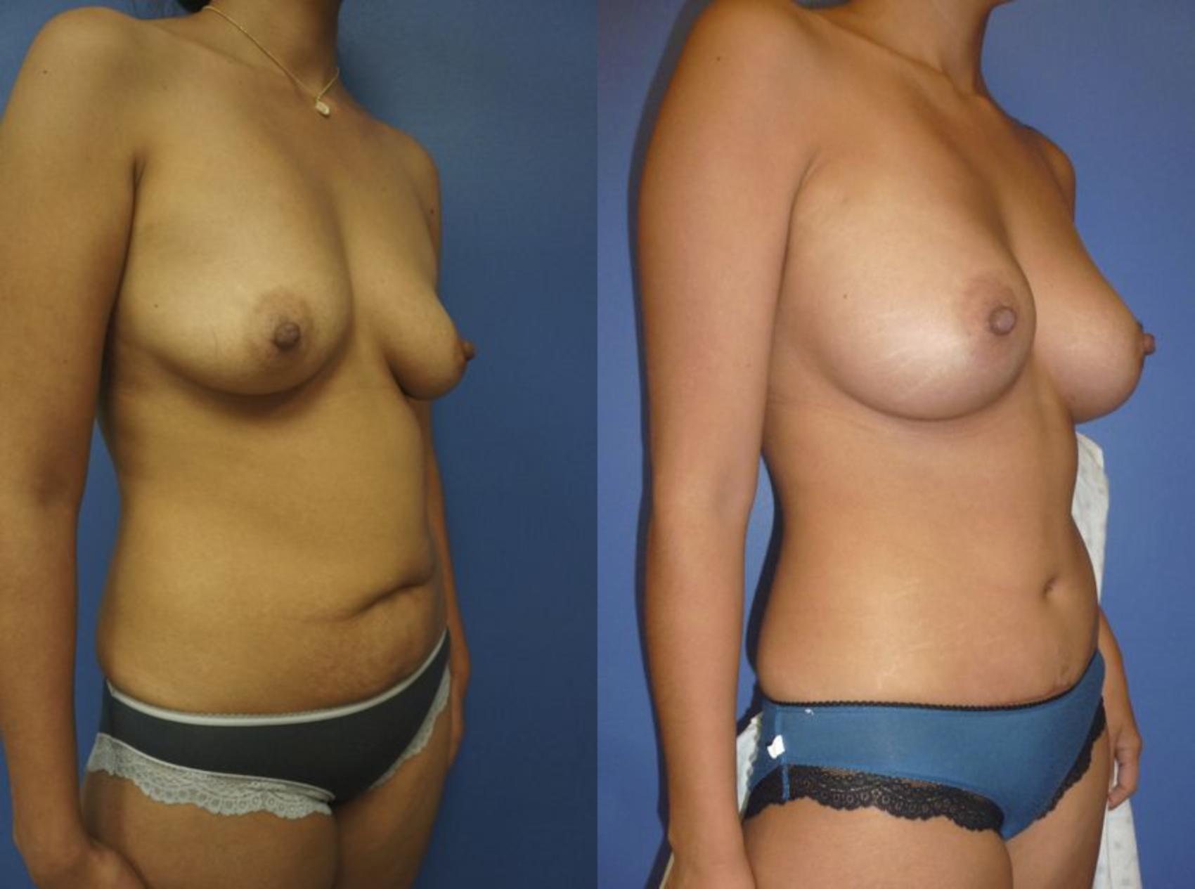 Before & After Tummy Tuck (Abdominoplasty) Case 27 View #2 View in Gilbert, AZ