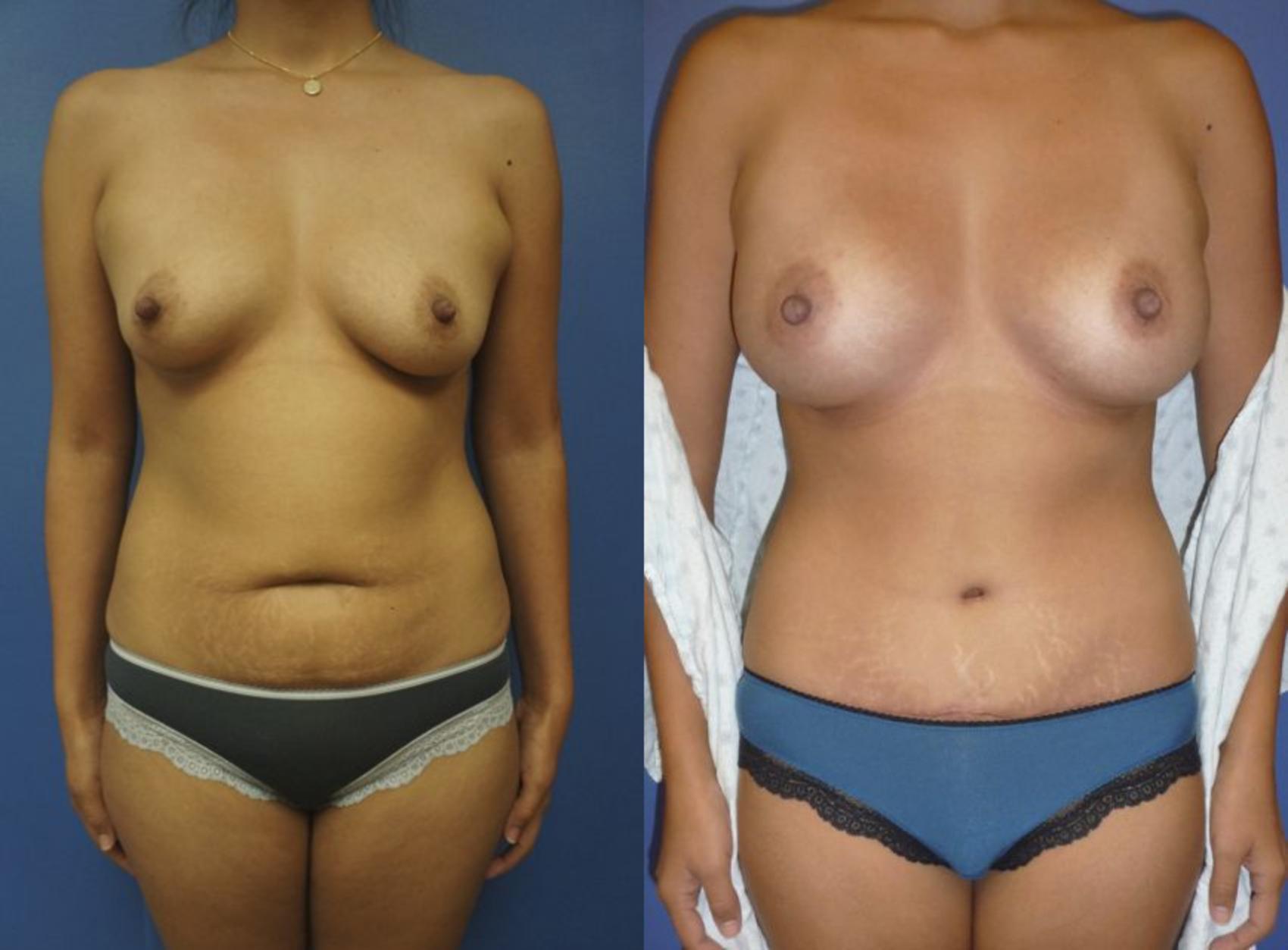 Before & After Tummy Tuck (Abdominoplasty) Case 27 View #3 View in Gilbert, AZ