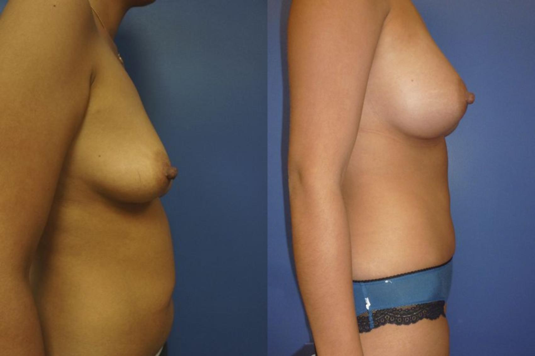 Before & After Tummy Tuck (Abdominoplasty) Case 27 View #4 View in Gilbert, AZ