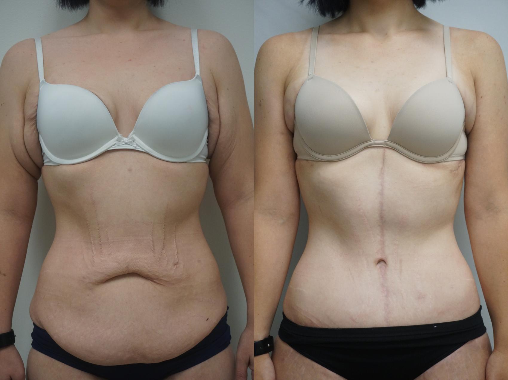 Before & After Fleur-de-Lis Tummy Tuck