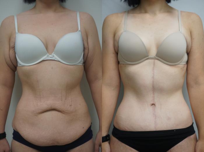 Before & After Tummy Tuck (Abdominoplasty) Case 273 View #1 View in Gilbert, AZ