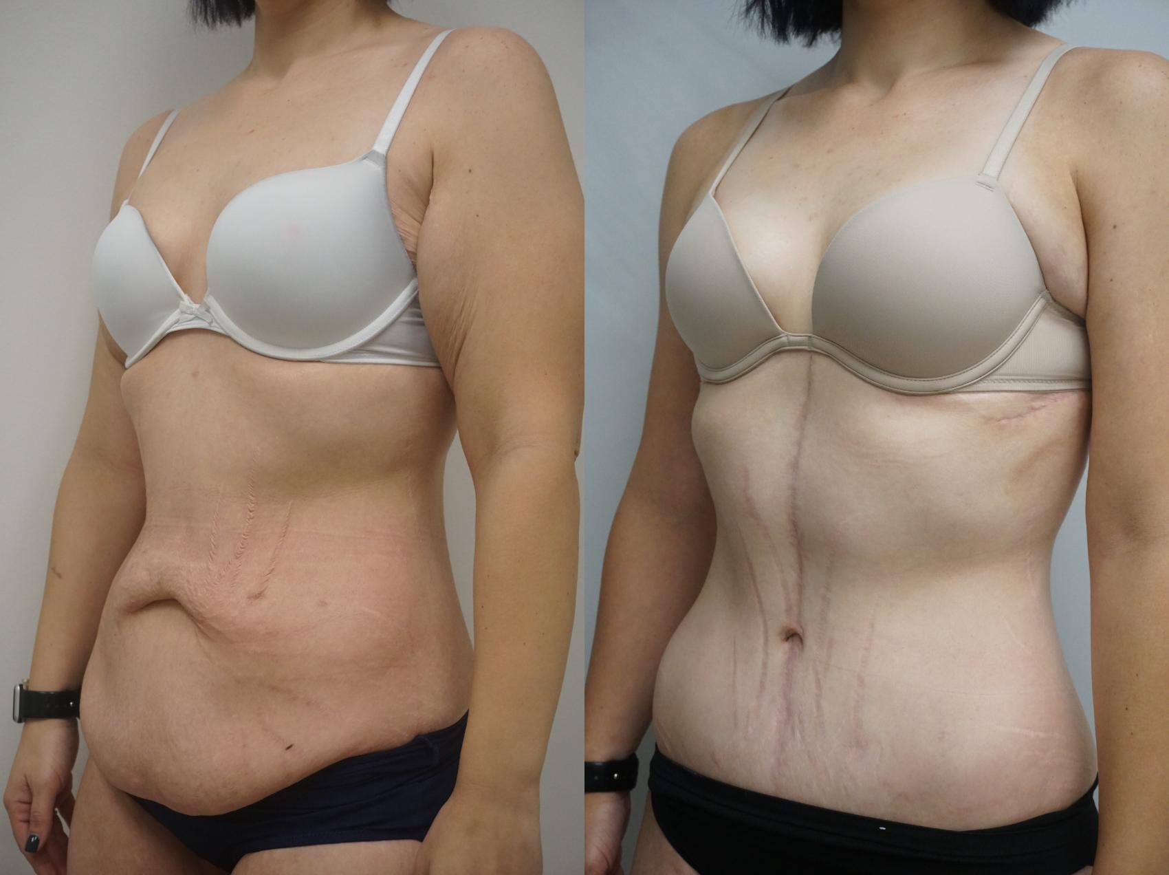 Before & After Tummy Tuck (Abdominoplasty) Case 273 View #2 View in Gilbert, AZ