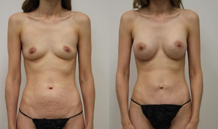 Before & After Tummy Tuck (Abdominoplasty) Case 28 View #1 View in Gilbert, AZ