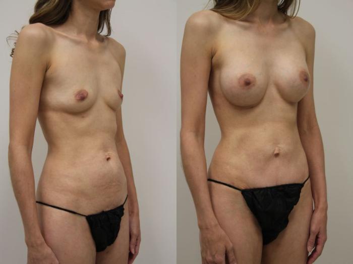 Before & After Tummy Tuck (Abdominoplasty) Case 28 View #2 View in Gilbert, AZ