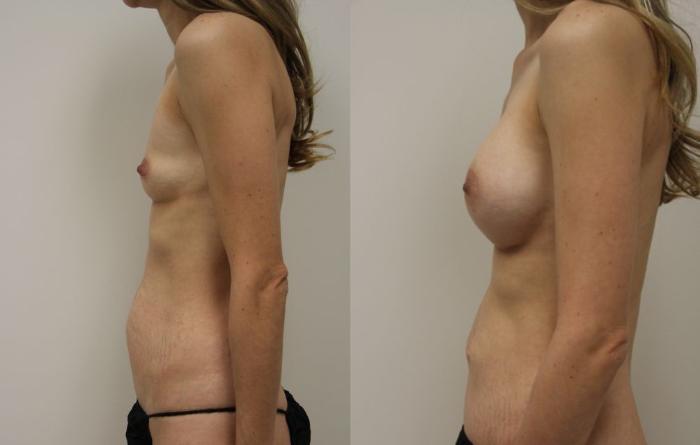 Before & After Tummy Tuck (Abdominoplasty) Case 28 View #3 View in Gilbert, AZ