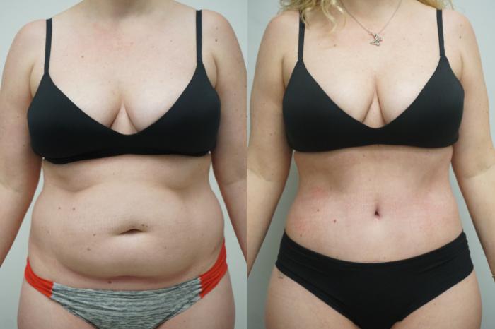 Before & After Liposuction Case 293 Front View in Gilbert, AZ
