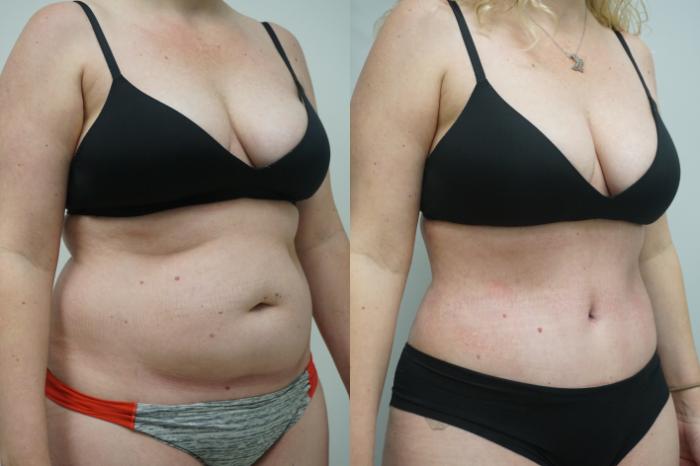 Before & After Tummy Tuck (Abdominoplasty) Case 293 Right Side View in Gilbert, AZ