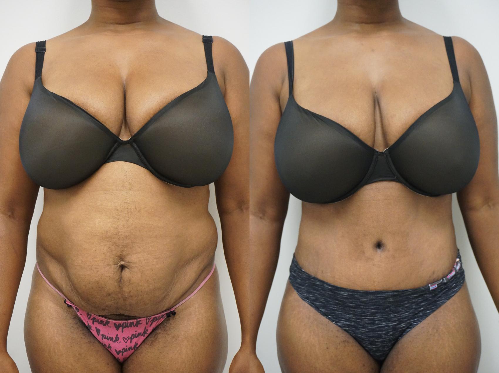 Before & After Liposuction Case 306 Front View in Gilbert, AZ