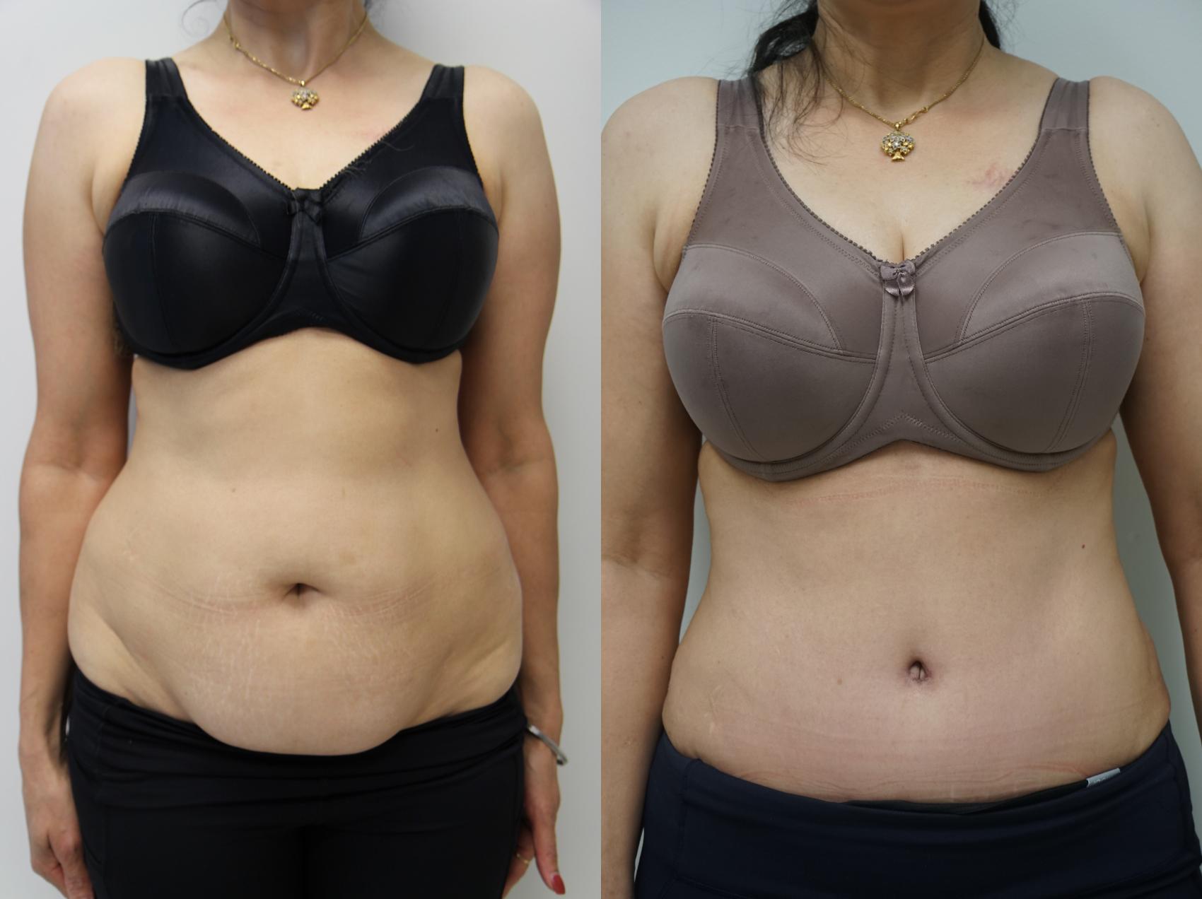 Before & After Tummy Tuck (Abdominoplasty) Case 317 Front View in Gilbert, AZ