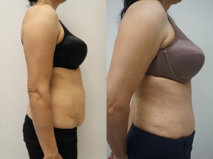 Before & After Tummy Tuck (Abdominoplasty) Case 317 Left Side View in Gilbert, AZ