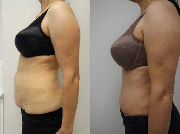 Before & After Tummy Tuck (Abdominoplasty) Case 317 Right Side View in Gilbert, AZ