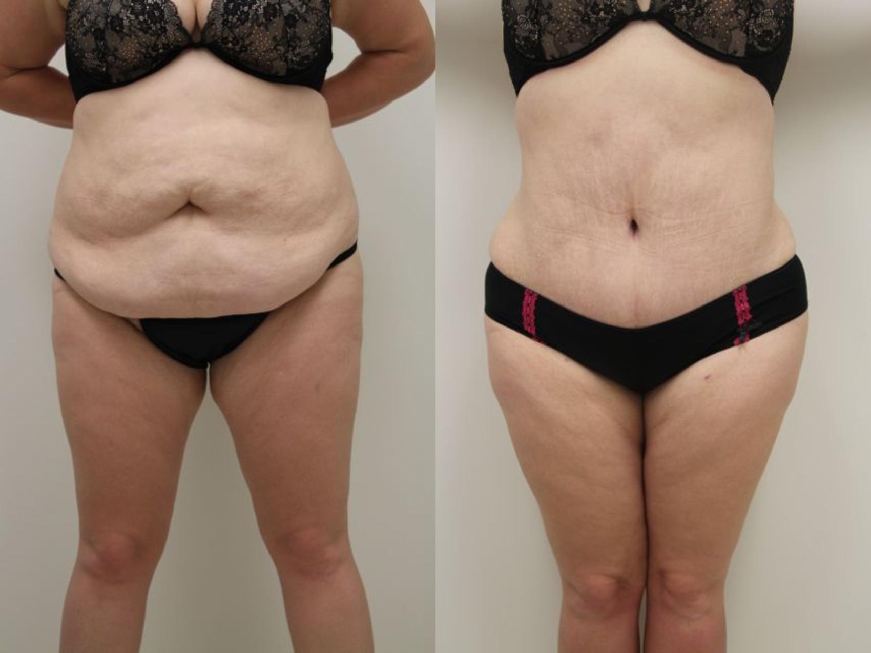 Before & After Tummy Tuck (Abdominoplasty) Case 32 View #1 View in Gilbert, AZ
