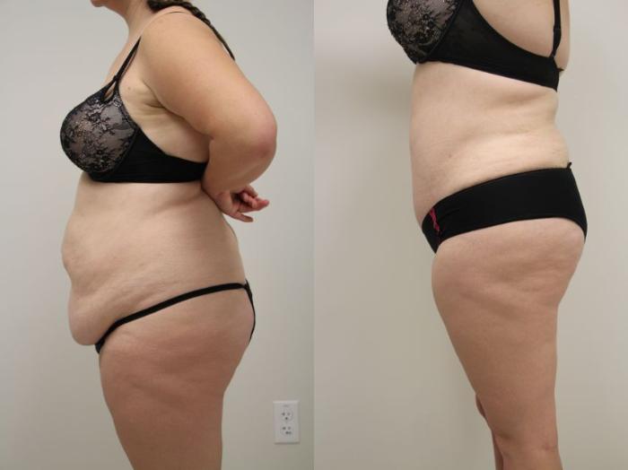 Before & After Tummy Tuck (Abdominoplasty) Case 32 View #4 View in Gilbert, AZ