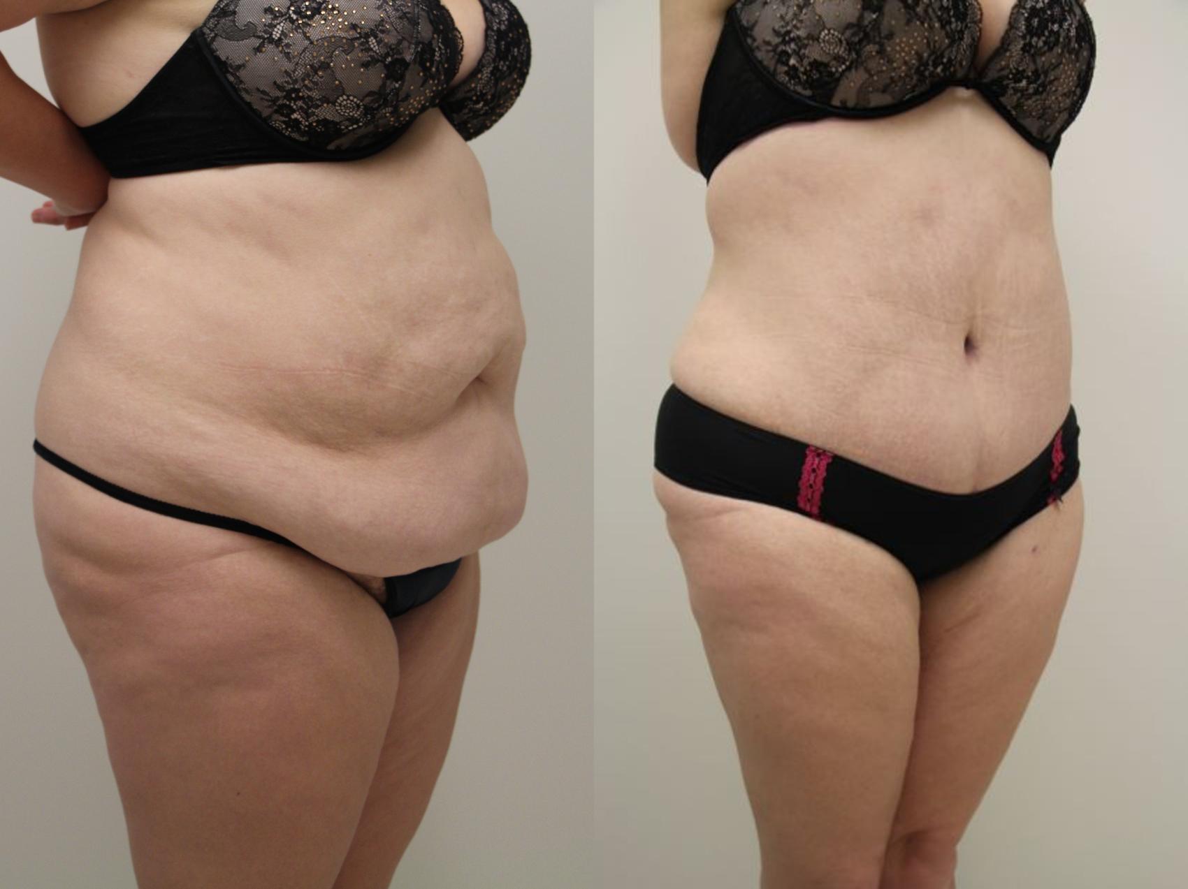 Before & After Abdominoplasty (Tummy Tuck) Case 32 View #5 View in Gilbert, AZ