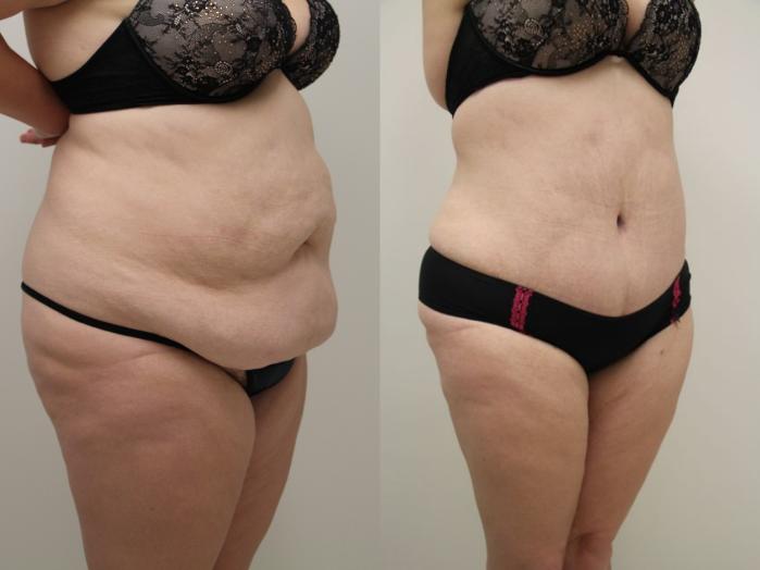 Before & After Tummy Tuck (Abdominoplasty) Case 32 View #5 View in Gilbert, AZ