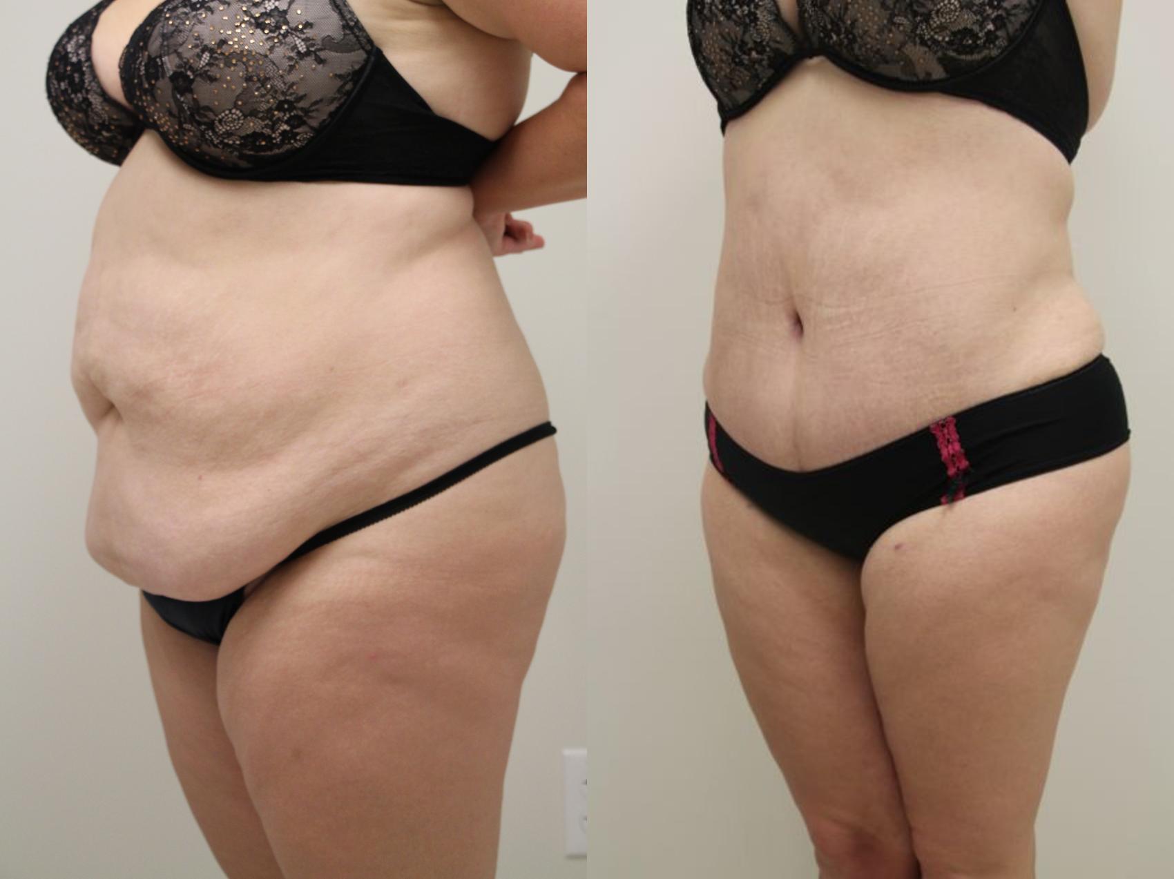 Before & After Abdominoplasty (Tummy Tuck) Case 32 View #6 View in Gilbert, AZ
