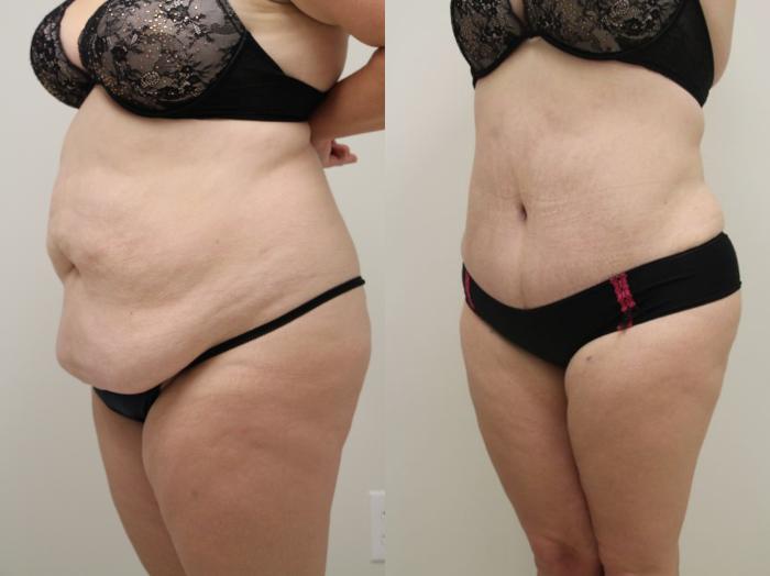 Before & After Tummy Tuck (Abdominoplasty) Case 32 View #6 View in Gilbert, AZ