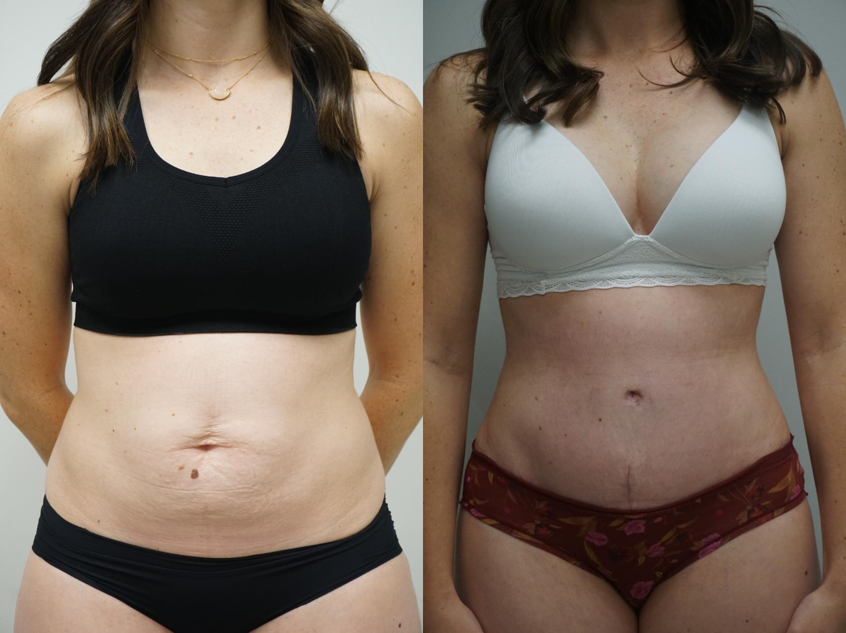 Unsure About Abdominoplasty? Learn the Top 10 Positives of Tummy Tuck  Surgery