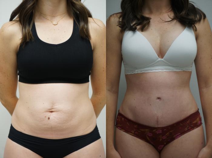 Before & After Tummy Tuck (Abdominoplasty) Case 324 Front View in Gilbert, AZ