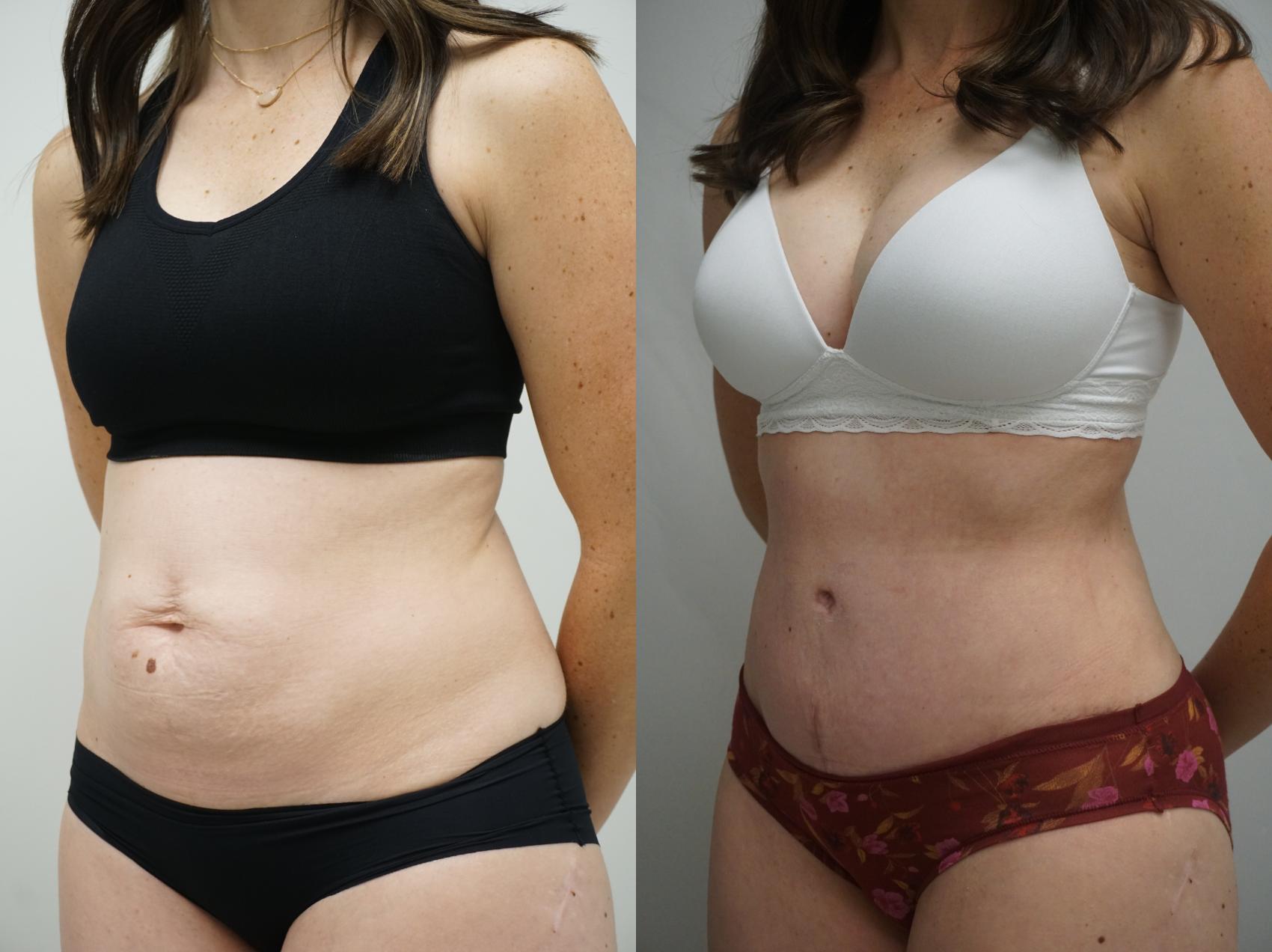 Before & After Tummy Tuck (Abdominoplasty) Case 324 Left Oblique View in Gilbert, AZ