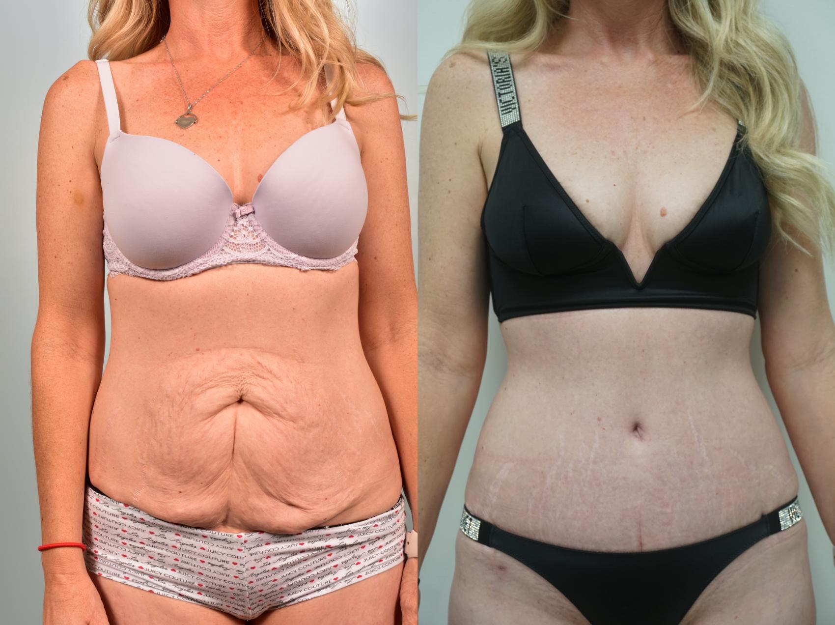 Before & After Tummy Tuck (Abdominoplasty) Case 328 Front View in Gilbert, AZ